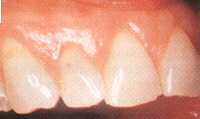 Fig. 10. Gingival recession of tooth No. 12 and no recession on the adjacent teeth. Tooth No.12 was hitting excessively hard in lateral movement. The lack of recession on either of the adjacent teeth demonstrates that excessive horizontal tooth brushing could not be the cause of the recession.