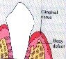 periodontal-disease-5